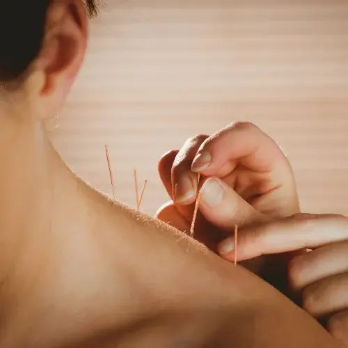 acupuncture-parkside-Mississauga, ON
